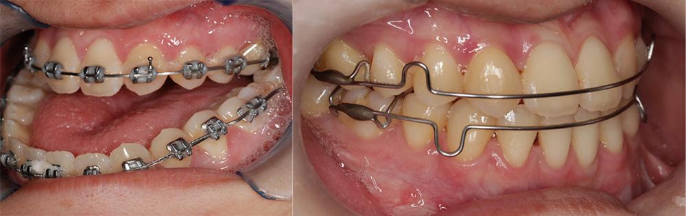 Asymmetric face and reversed bite