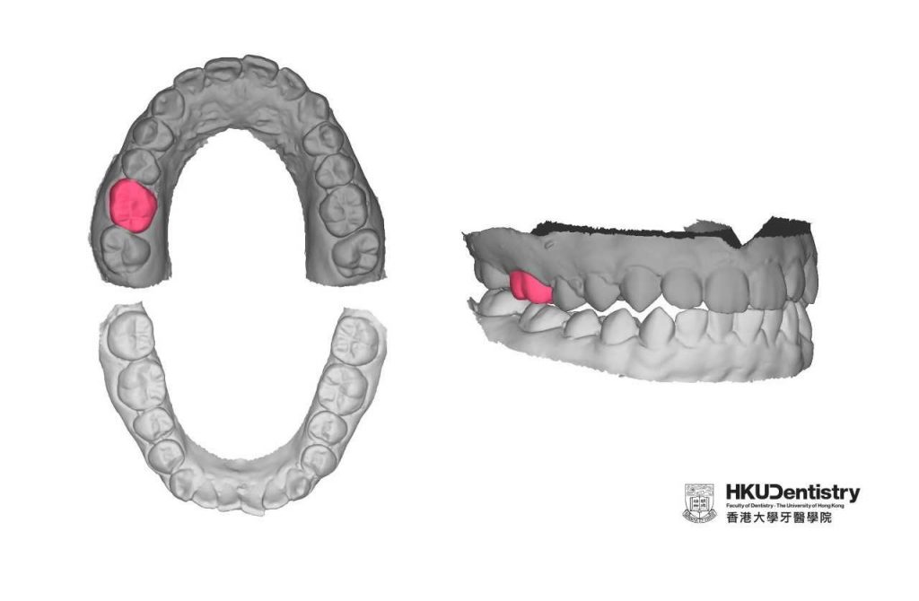 The research team uses the 3D Generative Adversarial Network (GAN) algorithm to learn the relationship of teeth in a dental arch on 175 student participants. After training, 3D GAN is able to generate a tooth (red) based on the feature of remaining teeth (dark grey).